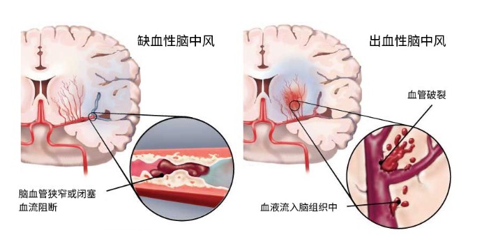 得了腦中風保險公司怎么賠